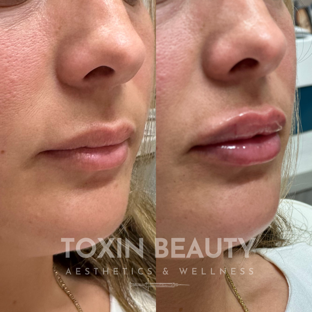 A woman with a lip augmentation before and after.