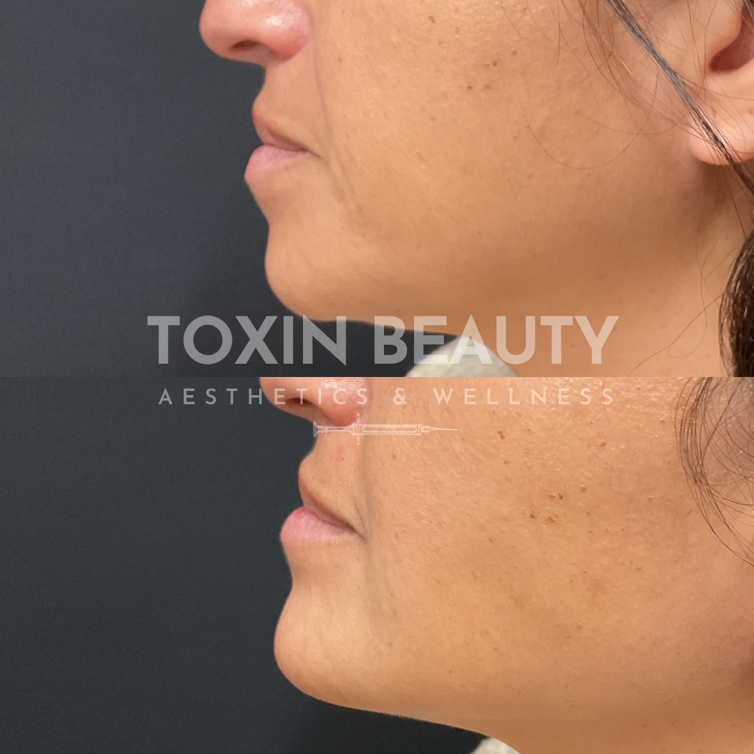 A woman 's face before and after botox treatment.