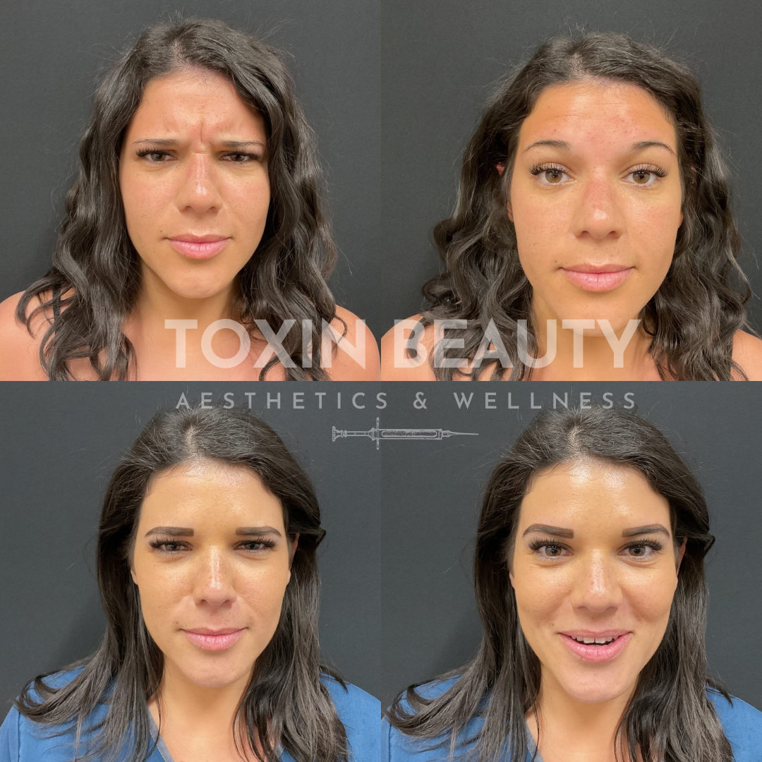 A woman with different expressions of acne and wrinkles.