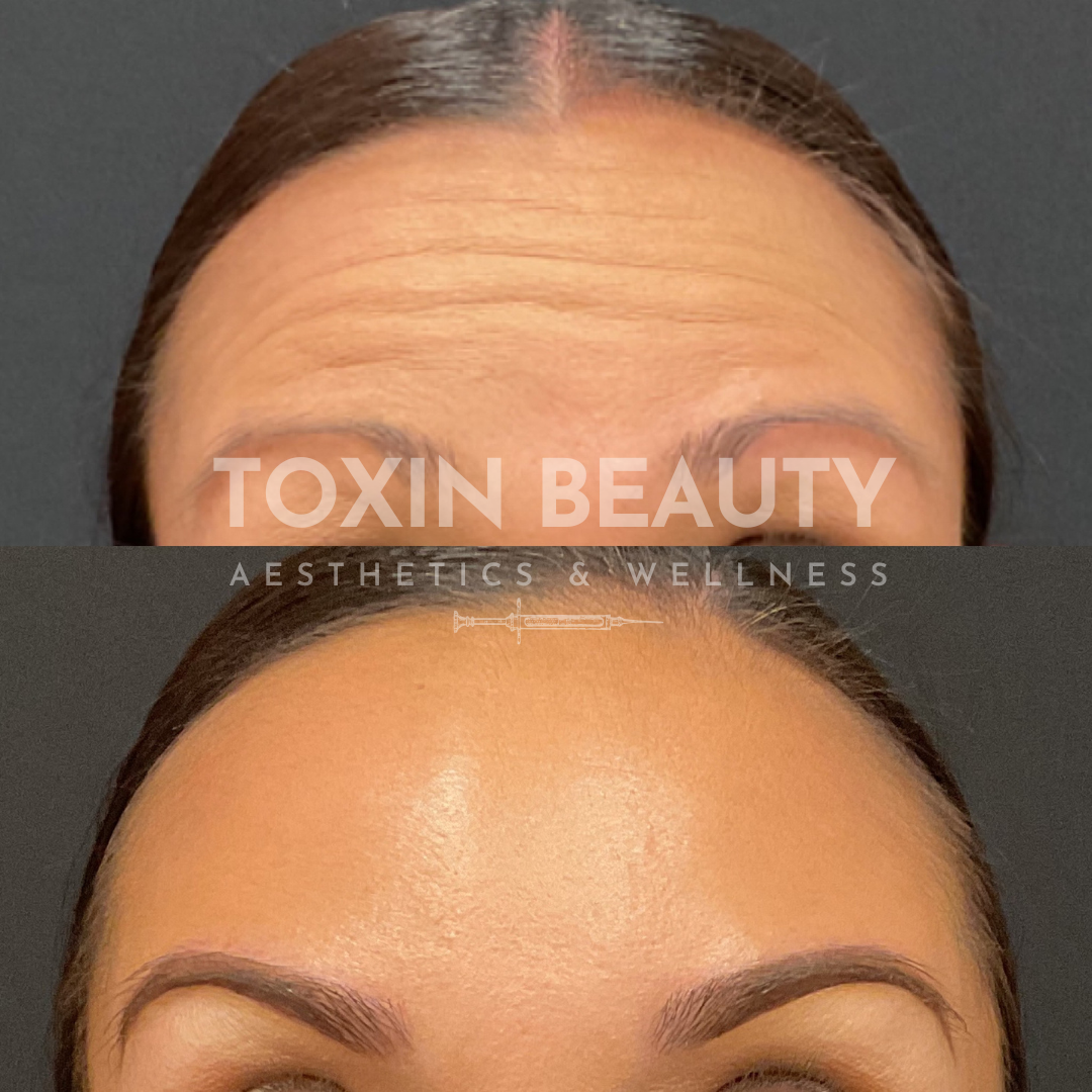 A woman 's face before and after botox.