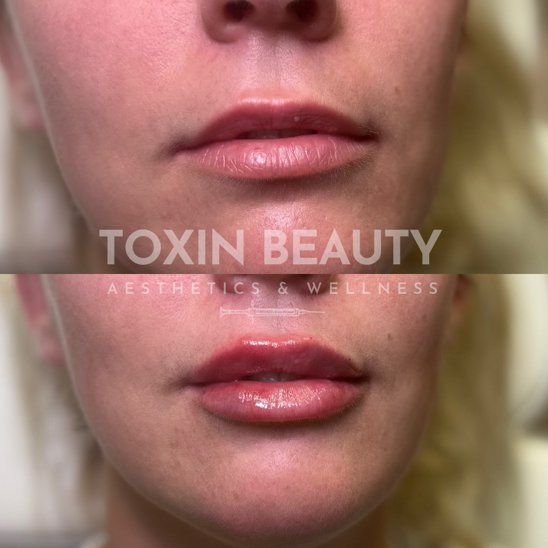 A woman 's lips before and after botox treatment.