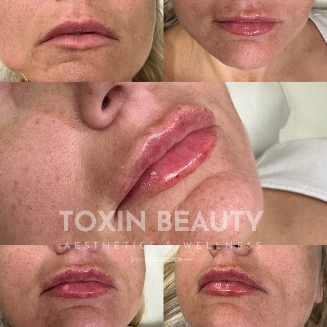 A woman with various stages of lip augmentation.