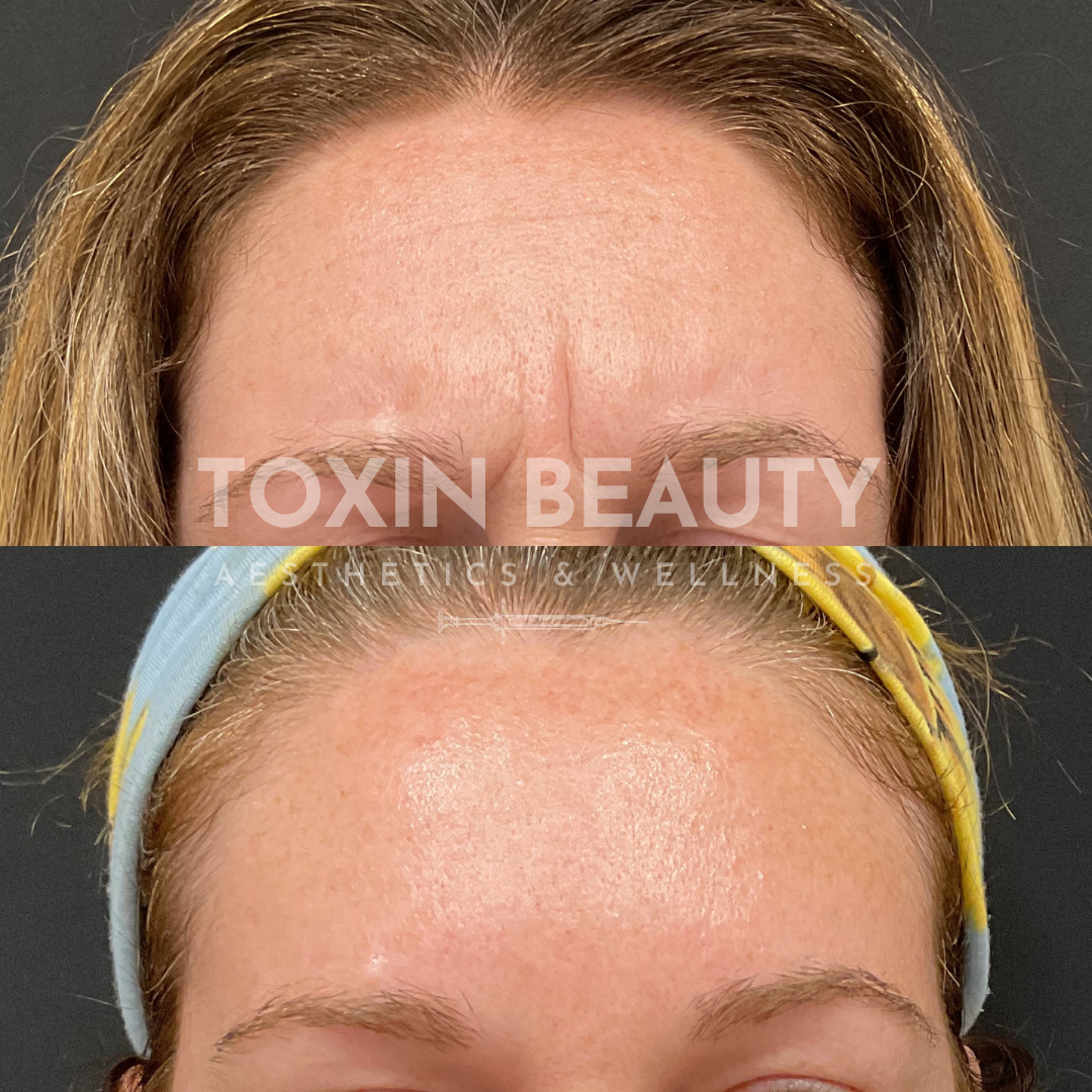 A before and after picture of botox for forehead lines.