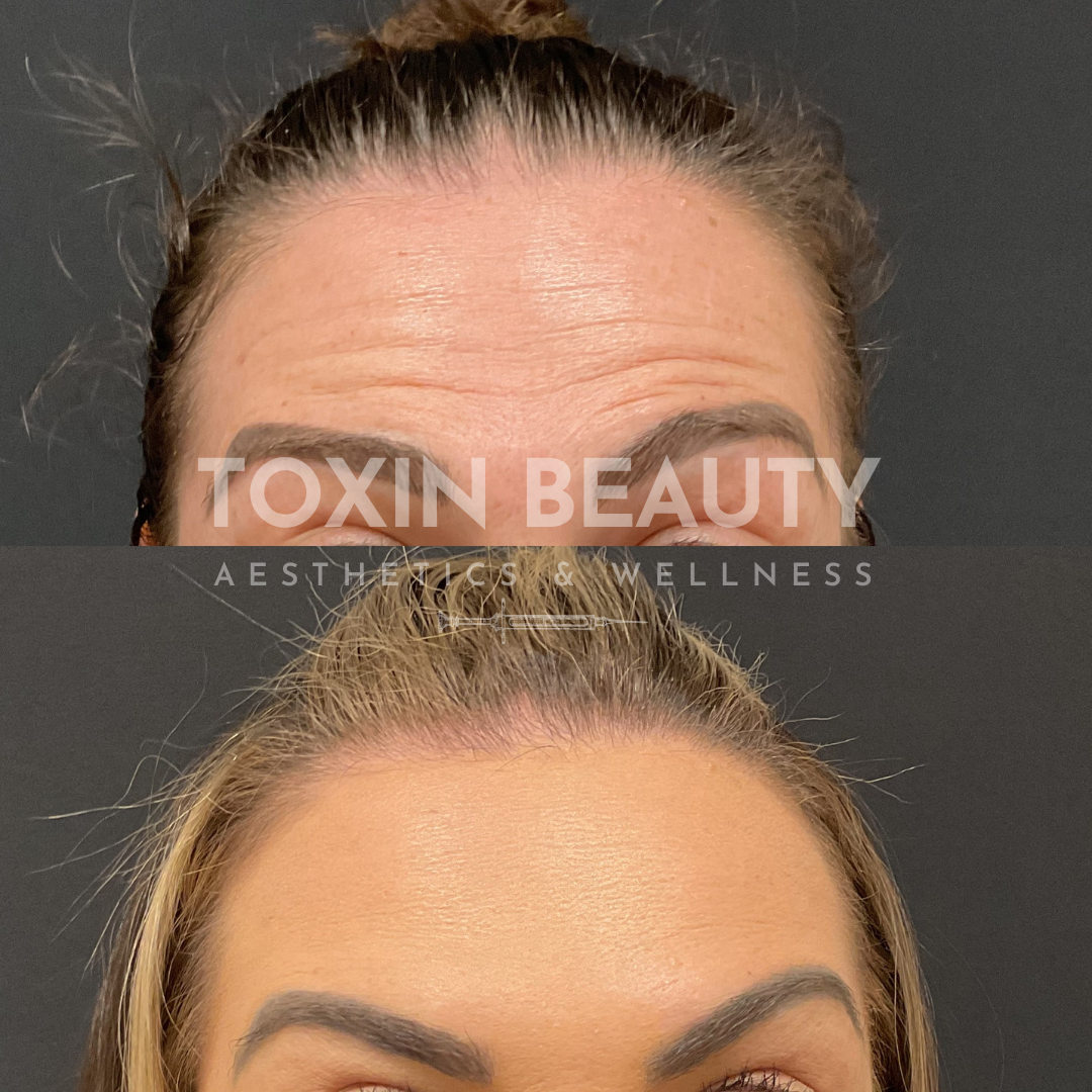 A before and after picture of botox for forehead lines.