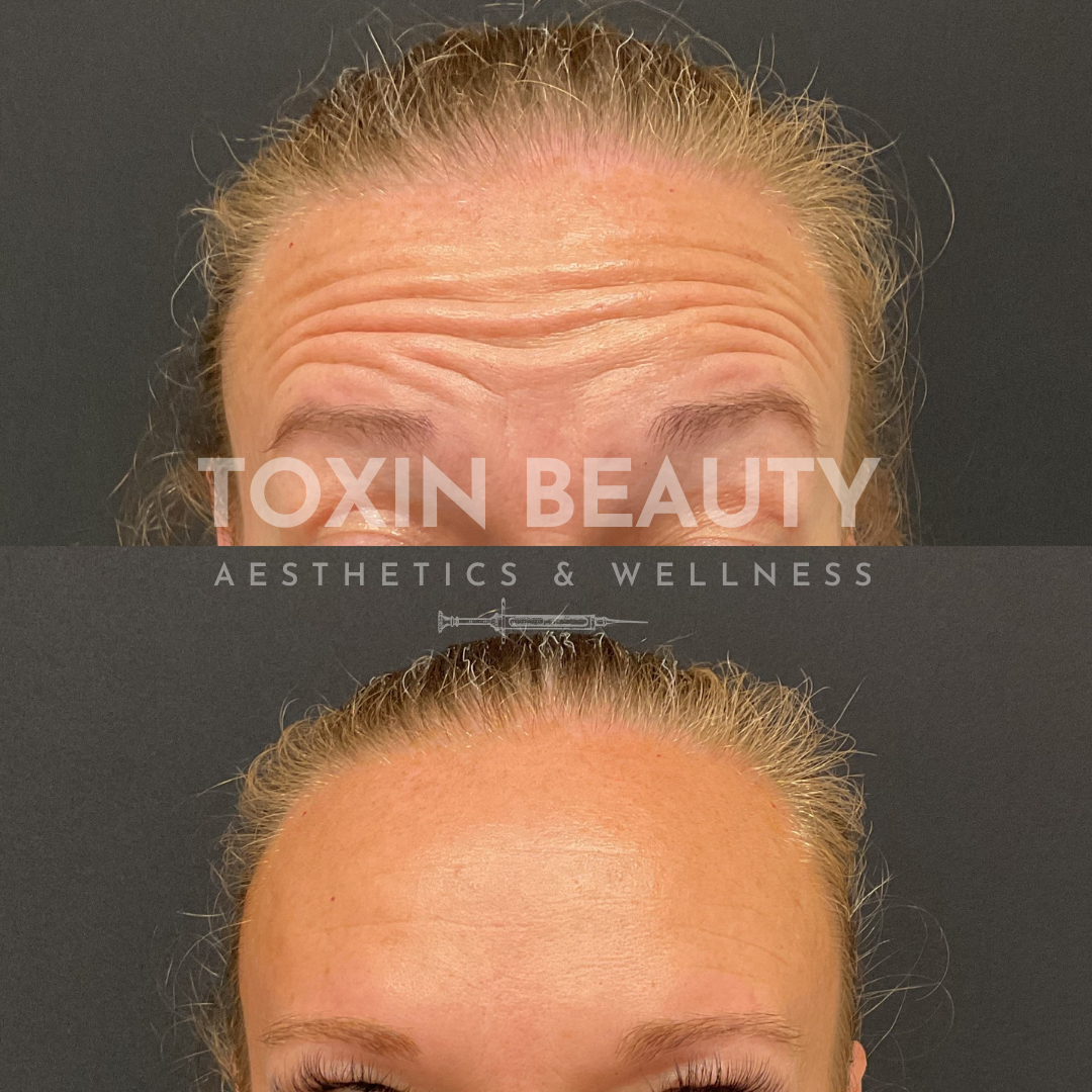 A before and after picture of botox for forehead lines.