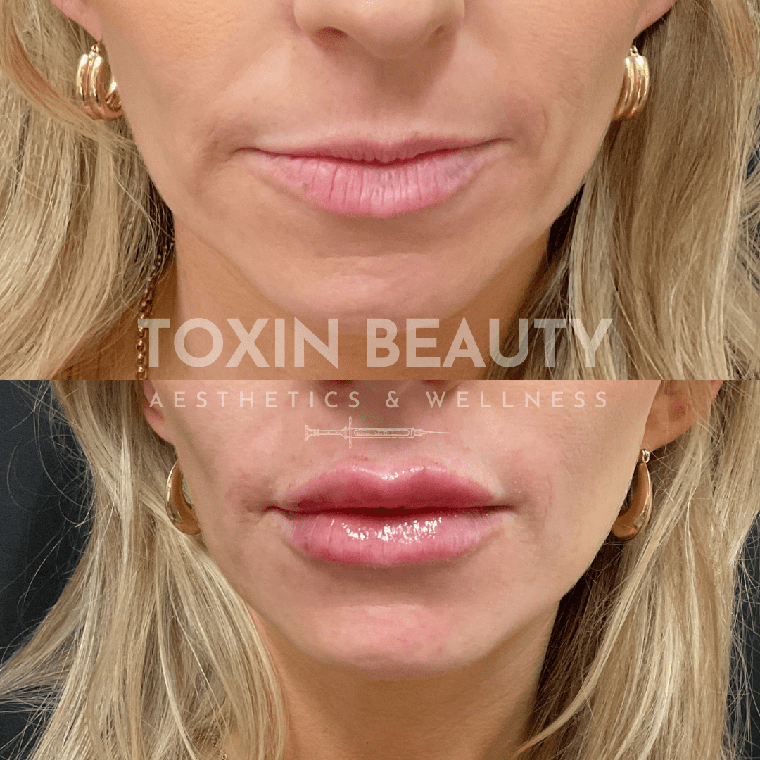 A before and after picture of a woman 's lips.